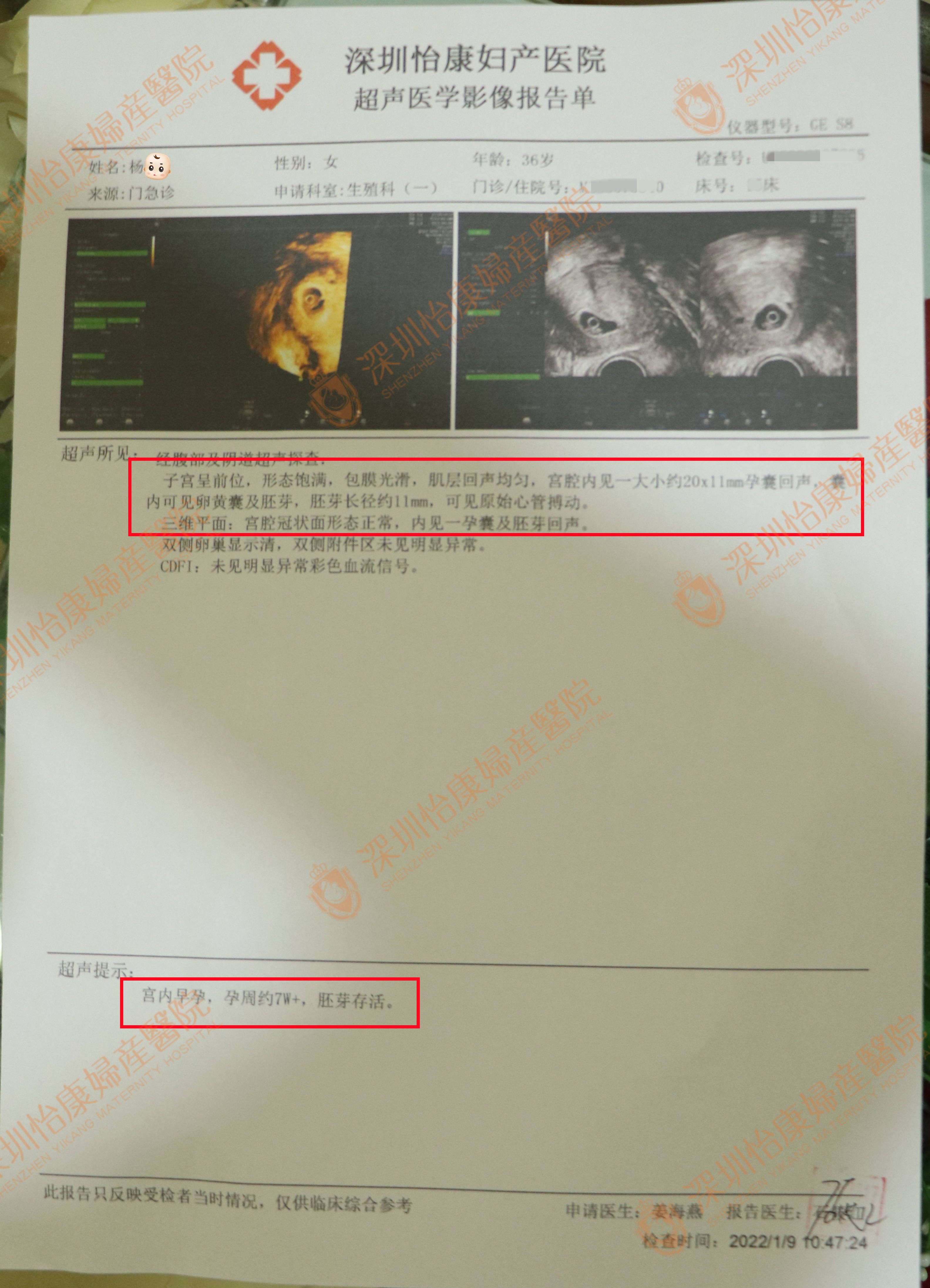 双侧输卵管间质部梗阻求孕未果 来怡康诊治成功为大宝再添虎伴