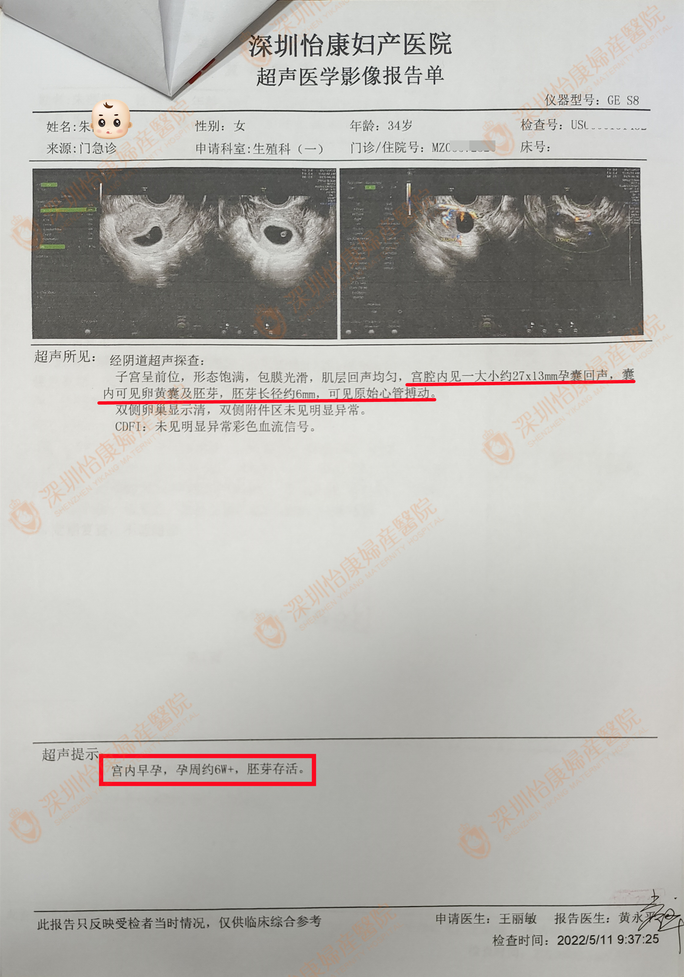 备孕二胎胎停2次1年未孕 夫妻同查同治现已孕6周+
