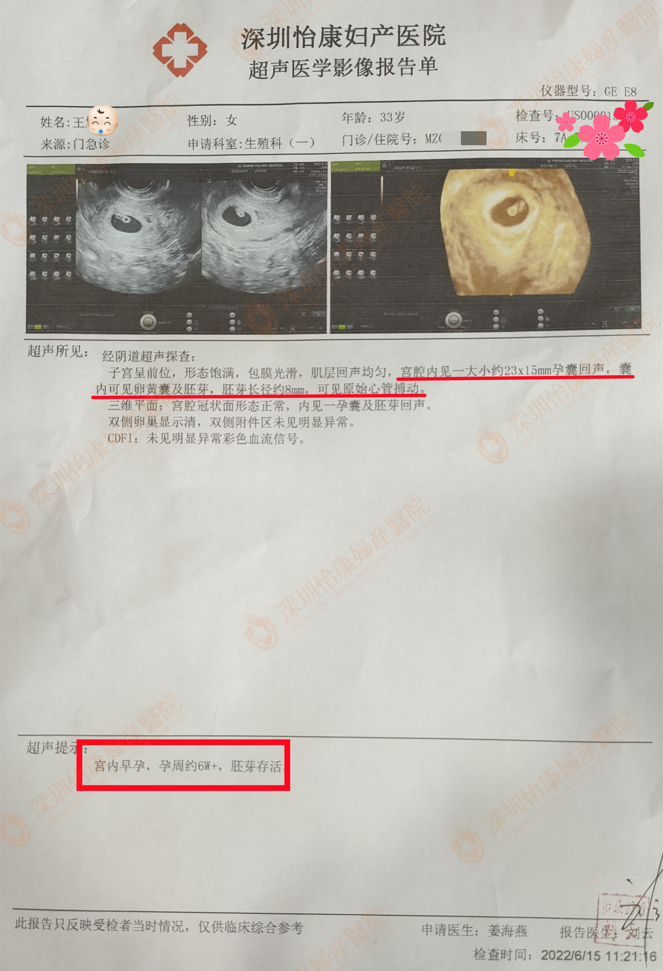 结扎7年后外院告知怀孕难  来怡康行复通术现已孕6周+