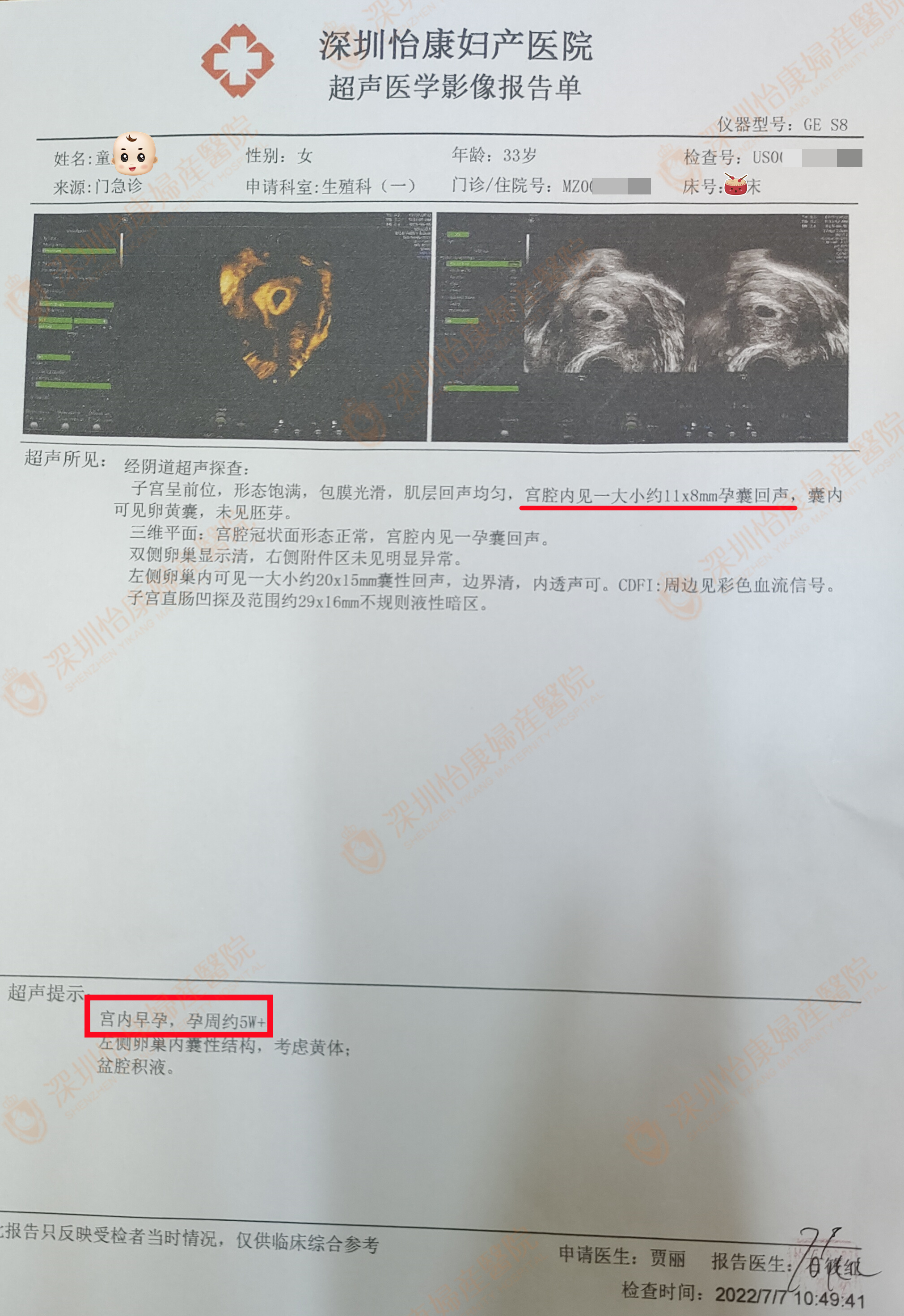 外院看诊1年后被建议试管 网上找到怡康现已孕5周+