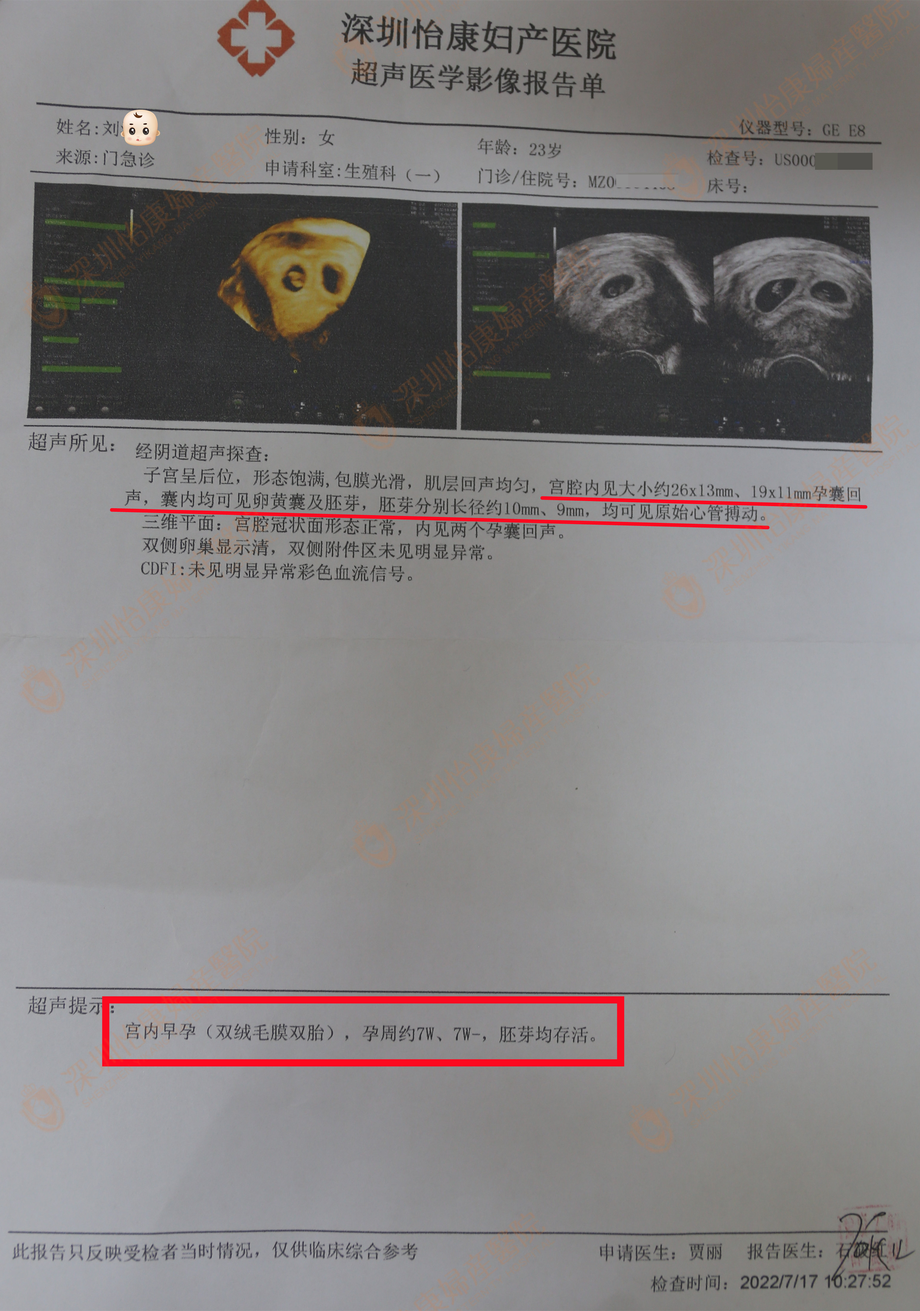 多囊备孕未果来怡康 促排1次喜怀双胞胎